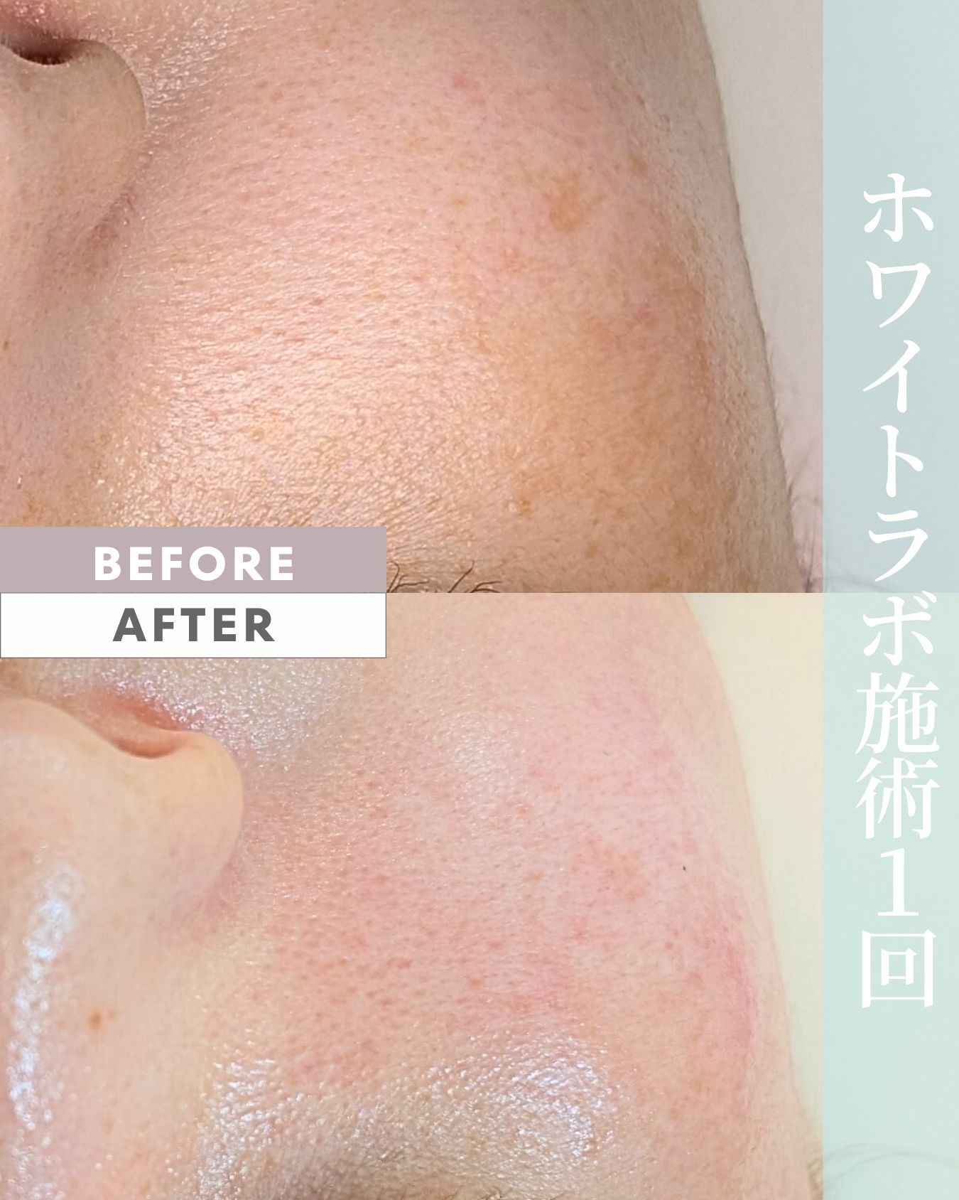 ホワイトラボ 1回目 ビフォーアフター